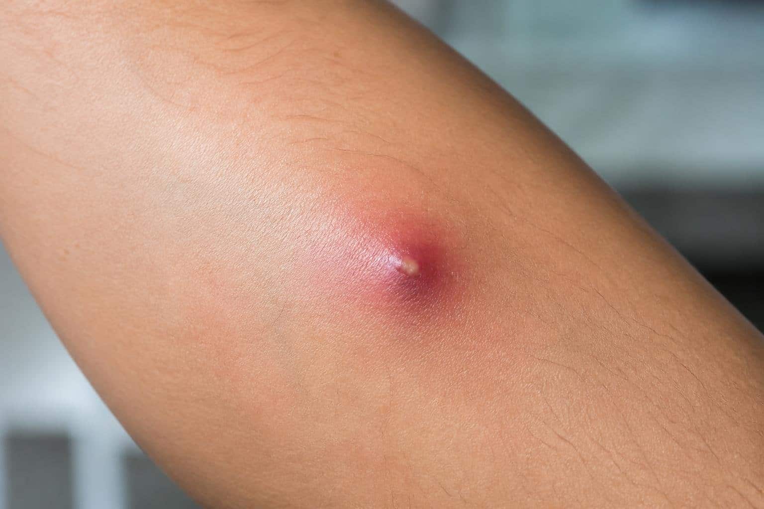 Close de uma pele humana com uma pequena infecção cutânea visível.